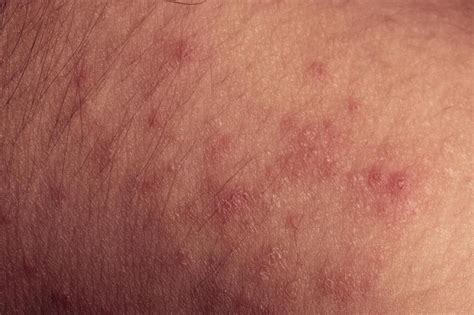 Allergic Skin Rashes That Itch Kinddon