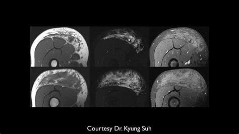 Mri Of Soft Tissue Tumors Pt 3 Youtube