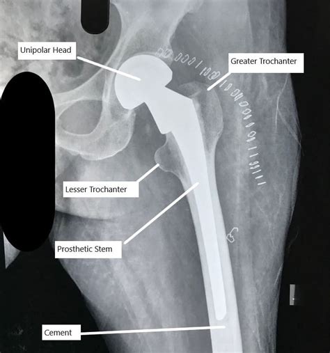 Partial Hip Replacement Vs Total Hip Replacement Complete Orthopedics