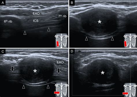 Neck Lipoma Ultrasound Images