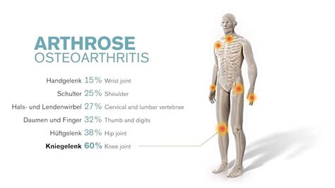 What Causes Osteoarthritis Ottobock Ca