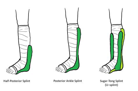 Stirrup U Shape Sprained Ankle Splint Kit