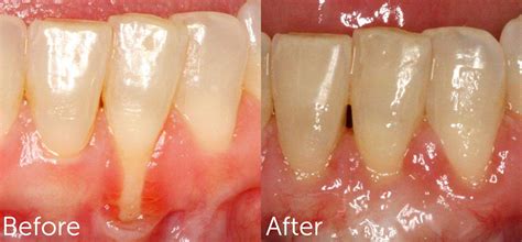 Gingiva mucosa is soft, flexible tissue, while keratinized gingiva is a much harder, designed to protect the roots of the teeth. Gum Grafting | Periodontist in Kansas City, MO