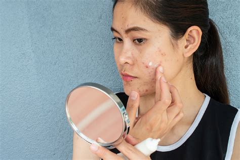 4 Skincare Habits That Might Make Your Acne Scars Worse