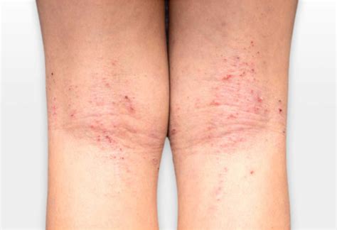 ¿qué Es La Dermatitis Atópica Pacientes En Red