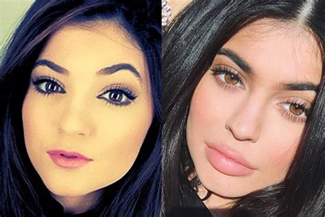 Kylie Jenners Lip Evolution