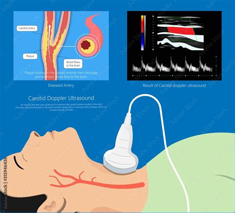Carotid Duplex Doppler Artery Ultrasound Disease Diagnosis Treatment