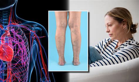 Varicose Veins Expert Explains If Heart Conditions Cause Condition