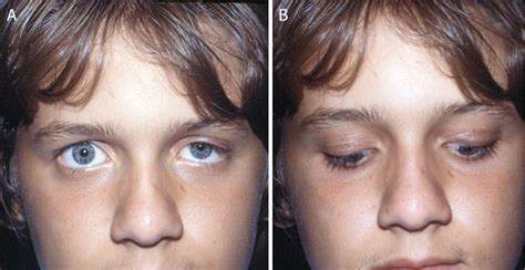 A Congenital Ptosis In A Child With Left Ptosis B The Pathognomonic
