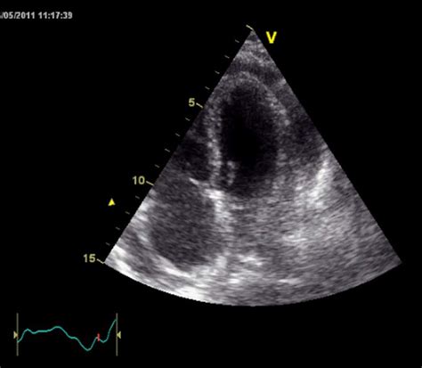 The Apical Four Chamber View Of The Transthoracic Echocardiogram