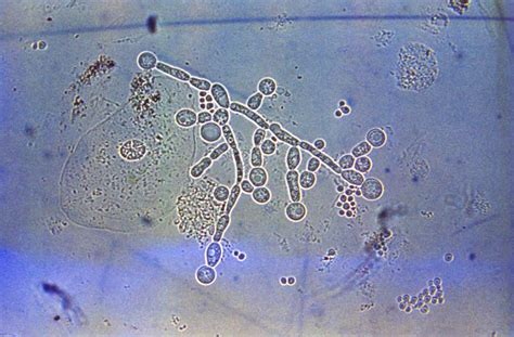 Candida Albicans Wikidoc