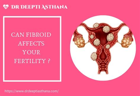 Can Fibroids Affects Your Fertility