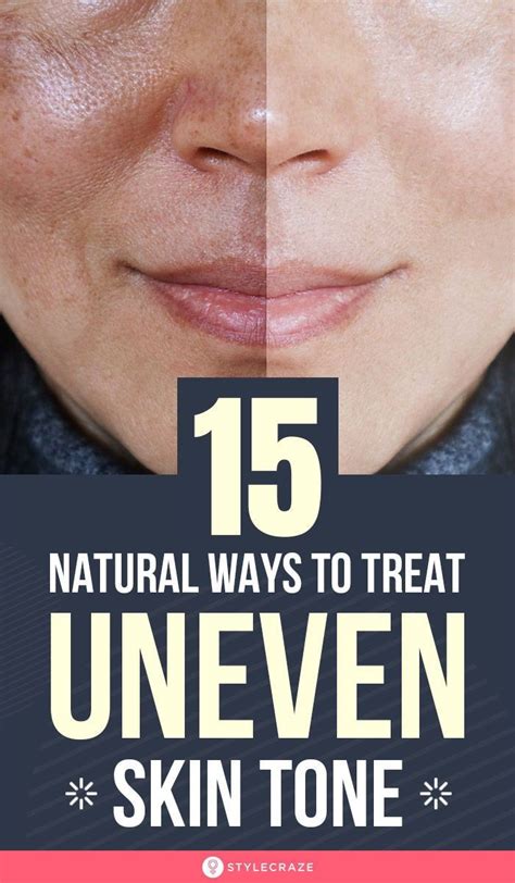 15 Home Remedies For Uneven Skin Tone The Road To Even Skin Tone