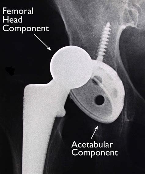Total Hip Replacement Orthoinfo Aaos