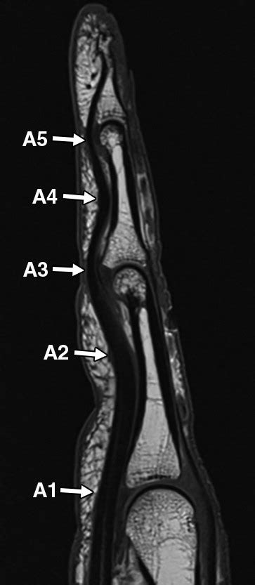 High Resolution T MRI Of The Fingers Review Of Anatomy And Common Tendon And Ligament