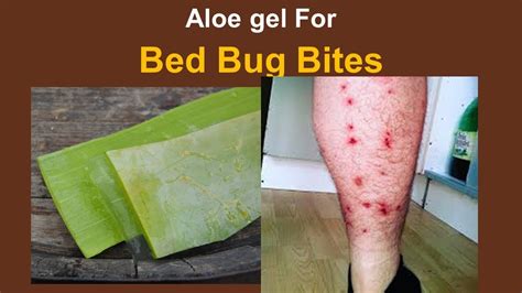 Home Remedies For Bed Bug Bites With Aloe Gel Water And Soap Youtube