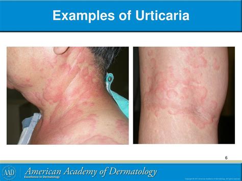 Ppt Urticaria Powerpoint Presentation Free Download Id4827313