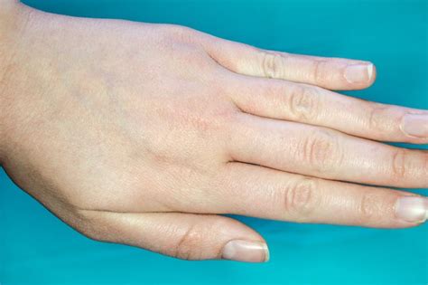 How To Get Rid Of Dry Skin On The Hands Livestrongcom