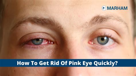 How To Get Rid Of Pink Eye Quickly Marham