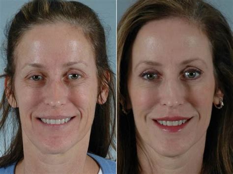 Botox Before And After Photos Philadelphia