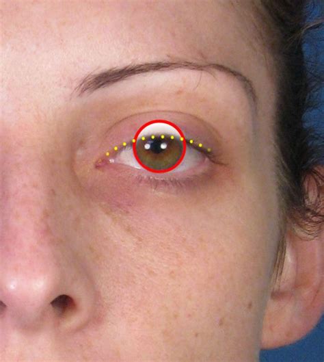 Ptosis Is The Medical Term For A Drooping Eyelid It Refers Only To The