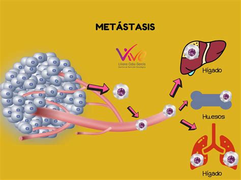 Cáncer De Mama Metastásico Alimentación Y Fortalecimiento Vive