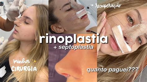 Fiz Rinoplastia Recupera O Pre Os Youtube