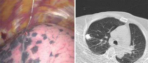 Ct Guided Hook Wire Localization With Lipiodol A Operative Finding