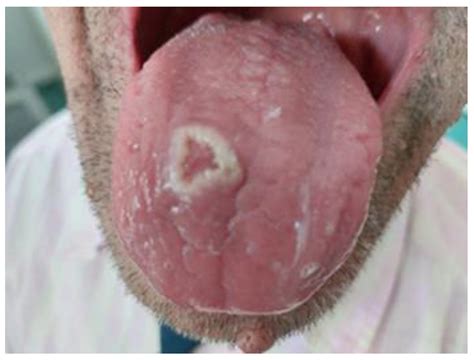 White Tongue Hiv