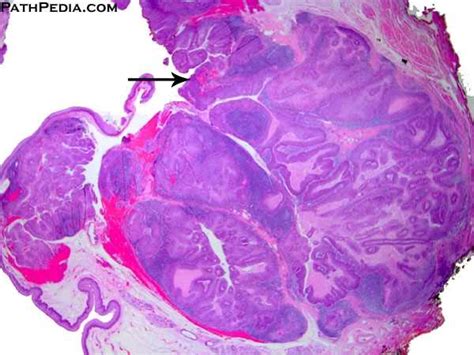 Histopathology Images Of Squamous Cell Carcinoma Tonsil By Pathpedia