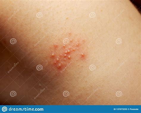 Rash And Other Nonspecific Skin Eruption Stock Image