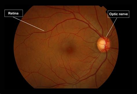 Optic Nerve Gene Vision