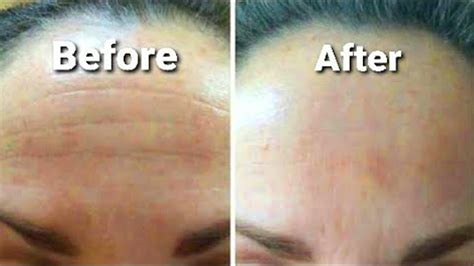 Forehead Wrinkle How To Get Rid Of Forehead Wrinkles For Deep Forehead