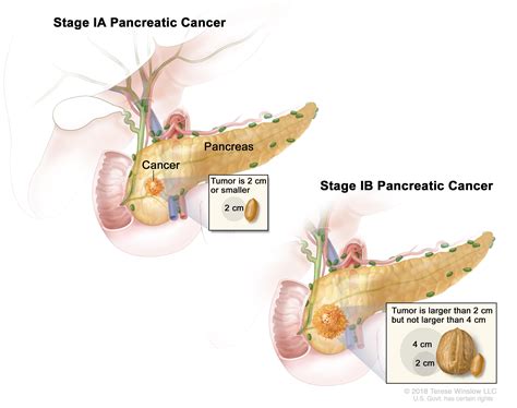 Pancreatic Cancer Prevention The Ruesch Center For The