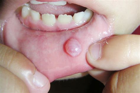 Learn Bump On Inside Of Lip Causes And Treatment Of White Spots