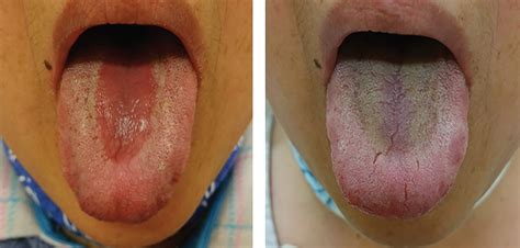 Median Rhomboid Glossitis Caused By Tongue Brushing Cleveland Clinic