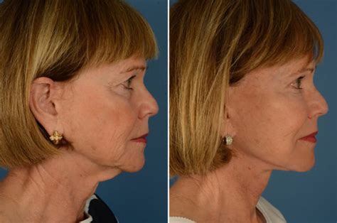 The Uplift™ Lower Face And Neck Lift Photos Naples Fl Patient 16233