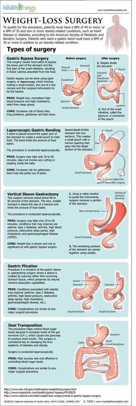 Infographic Types Of Weight Loss Surgery Live Science