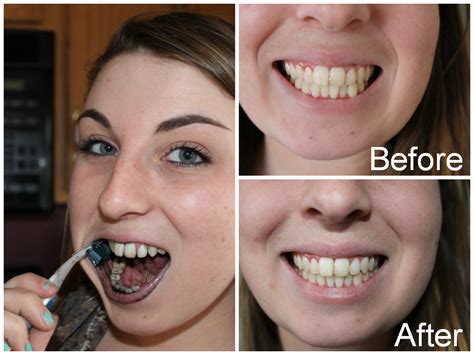 Whiten Teeth In 5 Minutes Break An Activated Charcoal Capsule In Half And Brush Your Teet