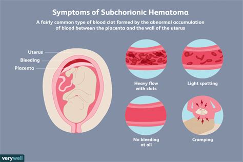 Subchorionic Hematoma And Pregnancy Risks