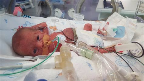 It's grown a lot since the earlier weeks of pregnancy when it was only the size of an apple seed or a lentil. 17-week premature baby fights for life after operations ...