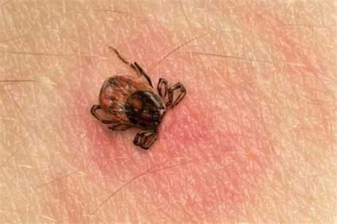 Die in drei stadien verlaufende erkrankung kann verschiedene organe in jeweils verschiedenen stadien und. Borreliose - Lyme-Borreliose Symptome | Gesundheitsportal