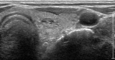 An Ultrasonography Us Image Of A Left Thyroid Nodule In A 77 Year Old