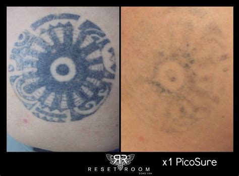 Whereas picosure only has two making it less useful for the removal of stubborn tattoo ink. Reset Room - Before & After Photos of Picosure Laser Tattoo Removal #tattooremovallaser | Tattoo ...