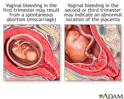 Vaginal Bleeding In Pregnancy Symptoms Doctors Treatments Advances More Medifind
