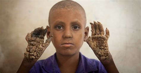 Meet The Boy Turning Into A Human Tree Because Of Extremely Rare And