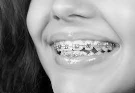 How do braces work?are there different types of braces?how much do rubber bands are used in cases that require slightly more pressure to straighten and direct your teeth into otherwise known as transparent braces, clear braces are extremely similar to metal braces. How Long Does It Take to Put Braces on | Dental braces ...