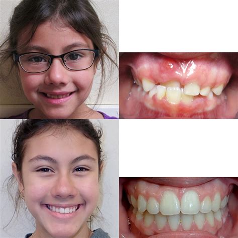 before and after braces wazio orthodontics
