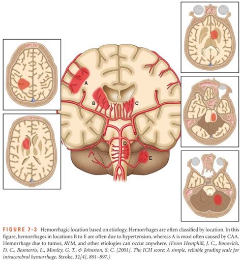 Here we see the patient suffering from movement and sensory symptoms associated with a stroke in the left middle cerebral artery. Intracerebral Hemorrhagic Stroke | Nurse Key