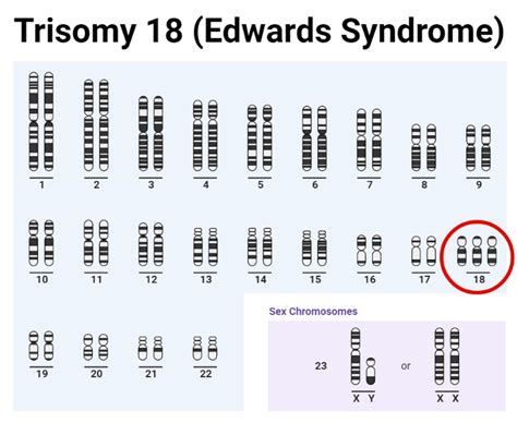 Trisomy Definition Causes Types Diagnosis Treatments